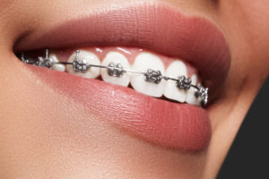 orthodontic treatment - braces